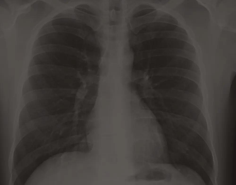 Radiografía de tórax que muestra la anatomía radiológica normal